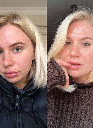 files/blemish-remover.jpg