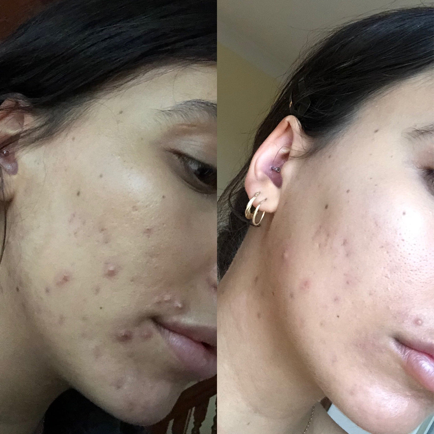 Rapid Blemish Spot Remover 30ml - Skóra Skincare